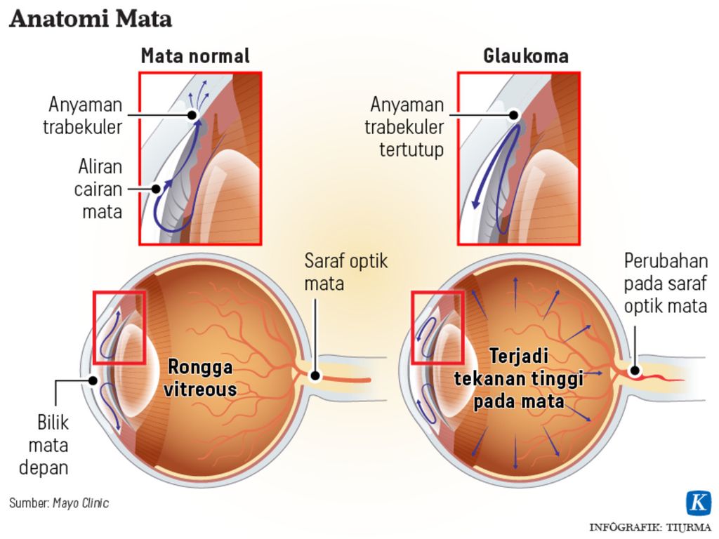 Infografik anatomi mata glaukoma