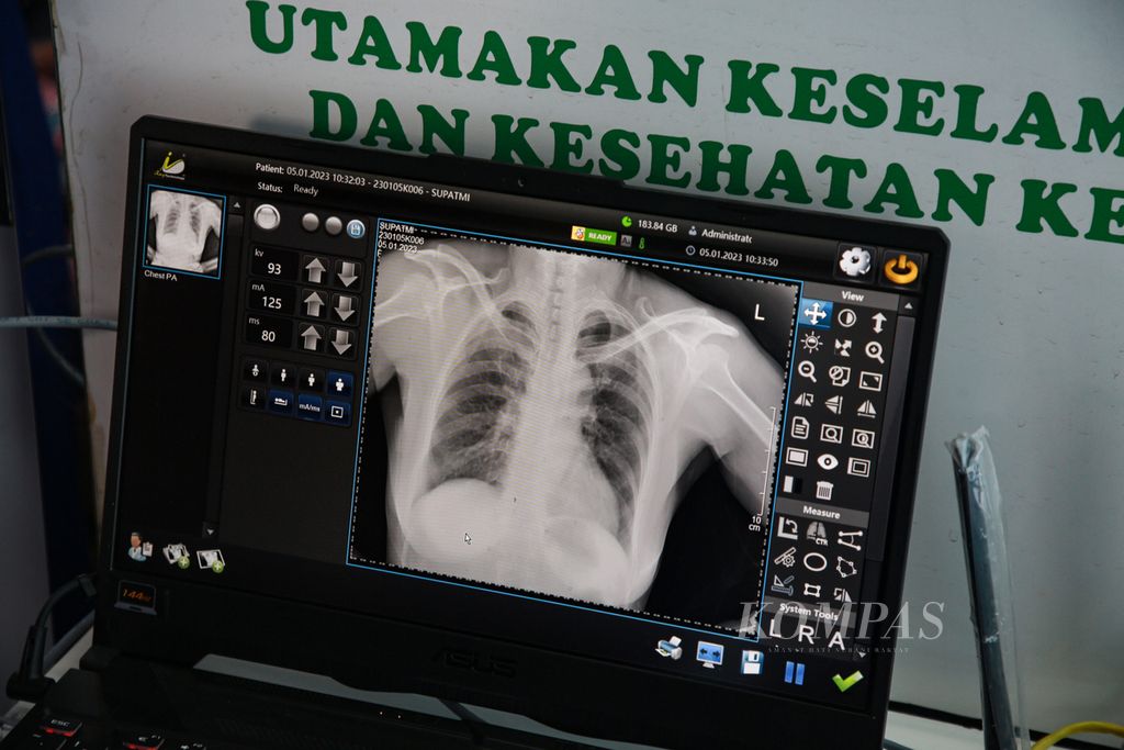 Hasil rontgen salah seorang warga dalam kegiatan Active Case Finding TBC di kantor Kecamatan Larangan, Kota Tangerang, Banten, Kamis (5/1/2023). Kegiatan penapisan tersebut merupakan upaya percepatan penemuan kasus TBC di masyarakat secara dini mengingat penyakit TBC adalah penyakit menular.
