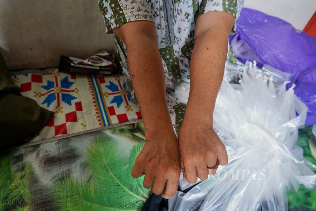 Yanti (40), warga Desa Fatufai, Bahodopi, Morowali, Sulawesi Tengah, menunjukkan iritasi tangan yang muncul seiring perubahan pesisir dan lingkungan setelah industri hilirisasi nikel masif.