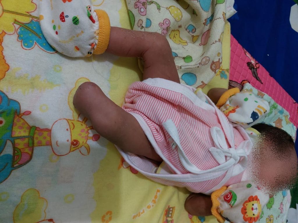 Bayi BR asal Pulang Pisau setelah bagian kaki kirinya diamputasi karena alami pembengkakan akibat penyumbatan pembuluh darah. Foto diambil saat ia masih dirawat di RSUD Doris Sylvanus setelah dirujuk dari RSUD Pulang Pisau, akhir Juli 2023.