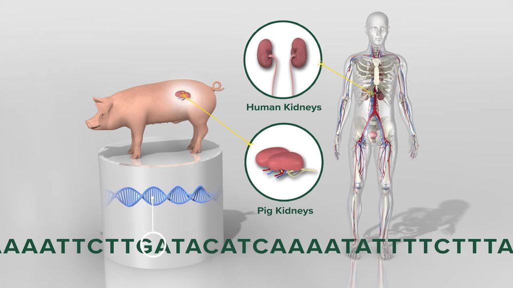 Ilustrasi transplantasi ginjal babi ke manusia.