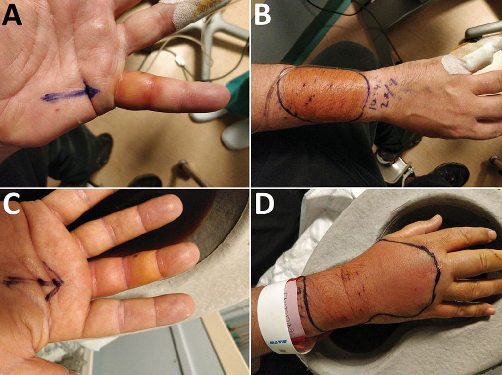 Kondisi tangan dan jari pasien (laki-laki usia 48 tahun) yang membengkak karena infeksi bakteri Globicatella akibat gigitan kucing liar di Inggris. Tampak (A) jari kecil kiri (B) tangan kanan (C) jari tengah tangan kanan (D) tangan kanan.
