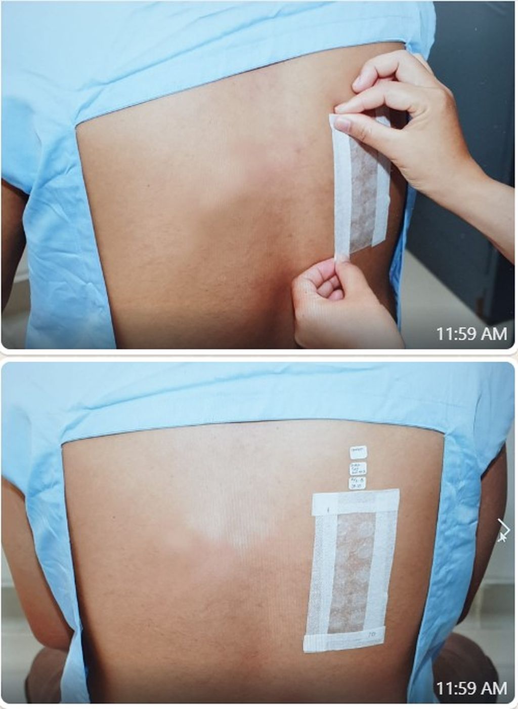 Penempelan Patch-Gen pada kulit punggung.