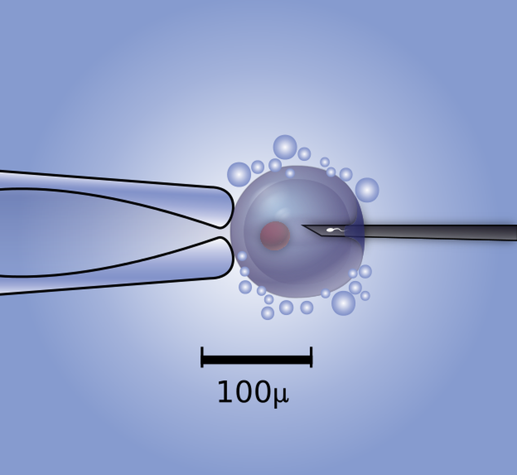 Gambaran proses injeksi sel sperma ke dalam sel telur melaui proses injeksi sperma intrasitoplasmik (ICSI). Teknik ini bisa membantu laki-laki dengan gangguan kesuburan untuk memiliki keturunan.