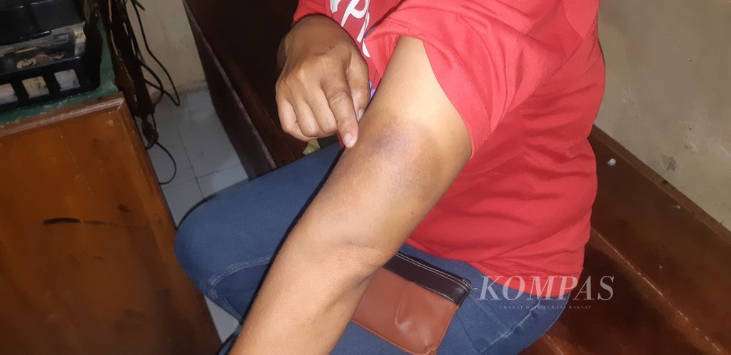 Seorang perempuan berinisial S menunjukkan luka bekas dugaan kasus kekerasan dalam rumah tangga kepada polisi di Kepolisian Sektor Gegesik, Kabupaten Cirebon, Jawa Barat, Selasa (21/11/2023). Korban diduga menjadi korban KDRT yang dilakukan oleh suaminya sendiri.