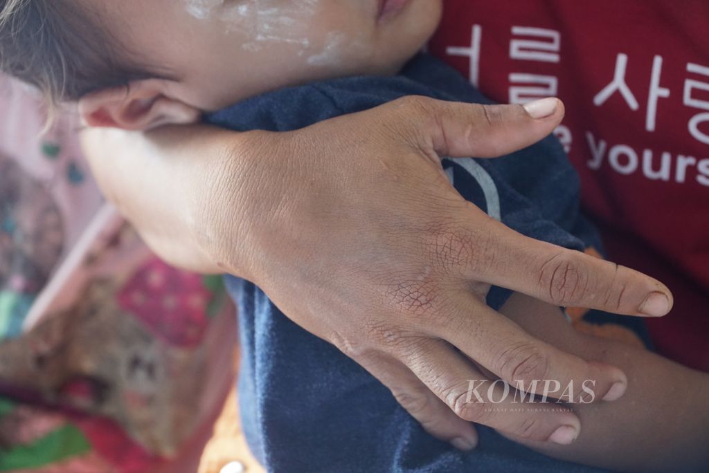 Seorang ibu menggendong anaknya yang mengalami tengkes atau <i>stunting</i> di Dusun Koritbuah, Desa Sinaka, Kecamatan Pagai Selatan, Kepulauan Mentawai, Sumatera Barat, Minggu (18/6/2023). Pada 23 Mei 2023, ada 29 kasus <i>stunting</i> di Desa Sinaka.