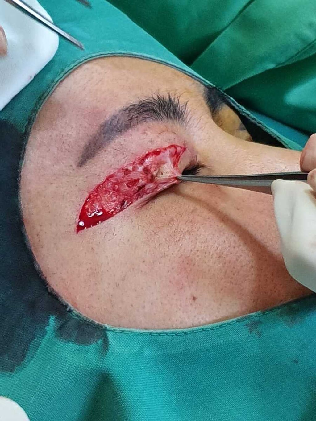 Dokumentasi operasi kelopak mata RA (35) yang dilakukan seorang dokter umum di rumahnya di daerah Ancol, Jakarta Utara, Desember 2020.