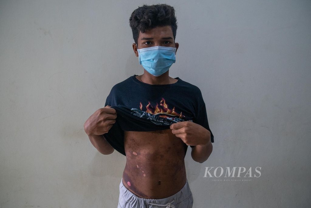 Zohir (21) menunjukkan luka di perut saat ditemui di rumah singgah Badan Pelindungan Pekerja Migran Indonesia di Batam, Kepulauan Riau, Selasa (21/6/2022). 