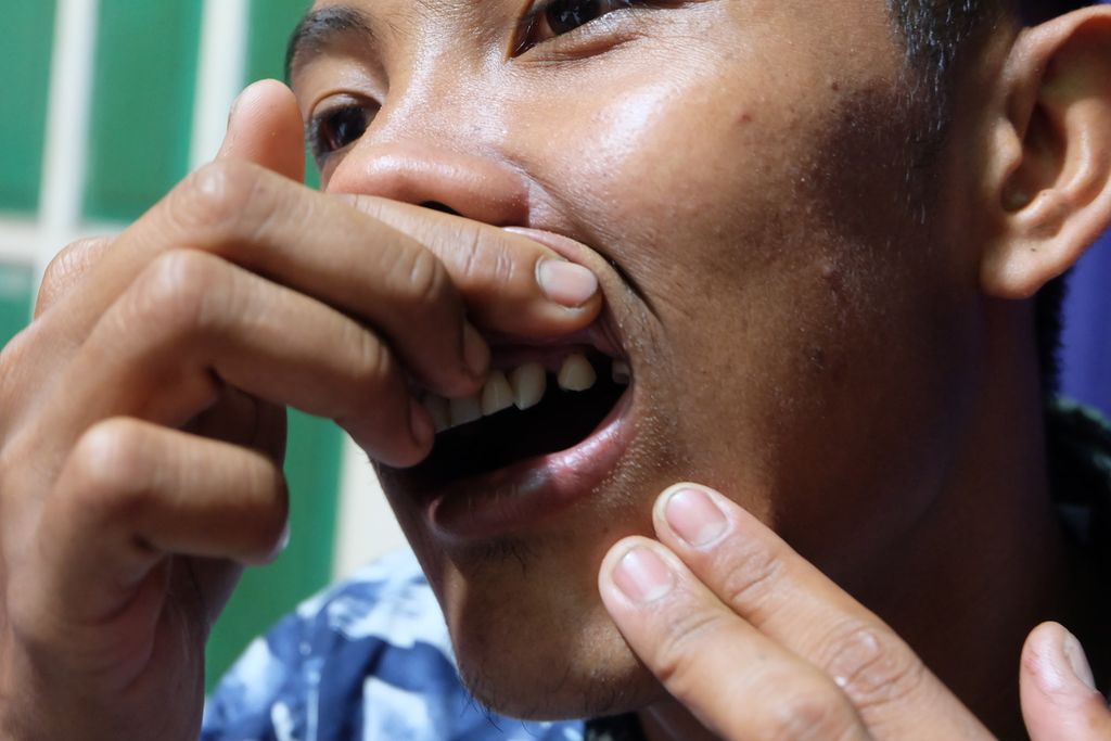 Adi Saputra, mantan anak buah kapal ikan China Tian Xiang 16, menunjukkan struktur giginya yang tak beraturan di rumahnya di Kabupaten Cirebon, Jawa Barat, Minggu (30/7/2023). Ia mengalami kekerasan di kapal tersebut pada 2018 dan salah satunya mengakibatkan giginya tanggal.