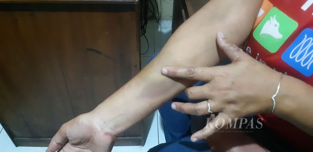 Seorang perempuan berinisial S menunjukkan luka bekas dugaan kasus kekerasan dalam rumah tangga kepada polisi di Kepolisian Sektor Gegesik, Kabupaten Cirebon, Jawa Barat, Selasa (21/11/2023). Korban diduga menjadi korban KDRT yang dilakukan oleh suaminya.
