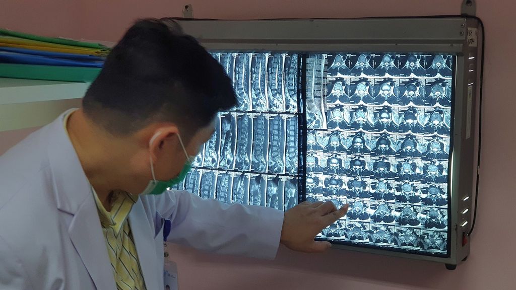 Dokter spesialis ortopedi dari Rumah Sakit Umum Pusat Fatmawati Jakarta, Phedy menunjukkan lembaran film hasil rontgen dari pasien skoliosis di RSUP Fatmawati, Jakarta, Jumat (10/3/2023).