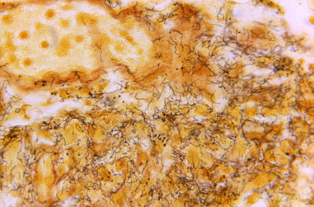 Foto mikroskop tahun 1966 dari Pusat Pengendalian dan Pencegahan Penyakit (CDC) Amerika Serikat ini menunjukkan sampel jaringan dengan adanya banyak <i>spirochetes Treponema pallidum</i> berbentuk pembuka botol, berwarna gelap, yang merupakan bakteri yang menyebabkan sifilis. 