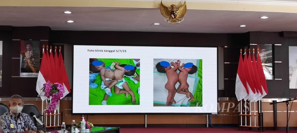 Rumah Sakit Umum Daerah Saiful Anwar Provinsi Jawa Timur di Kota Malang akan melakukan operasi pemisahan kembar siam Aliyah dan Aisyah (11 bulan) asal Pasuruan, Jawa Timur. Operasi dijadwalkan pada Sabtu (12/8/2023). Kedua anak bernama Aliyah dan Aisyah (11 bulan) tersebut mengalami penyatuan organ hati/liver dan sebagian tulang dada. Kamis (10/8/2023), tim dokter RSSA memberikan keterangan pers terkait rencana operasi itu.