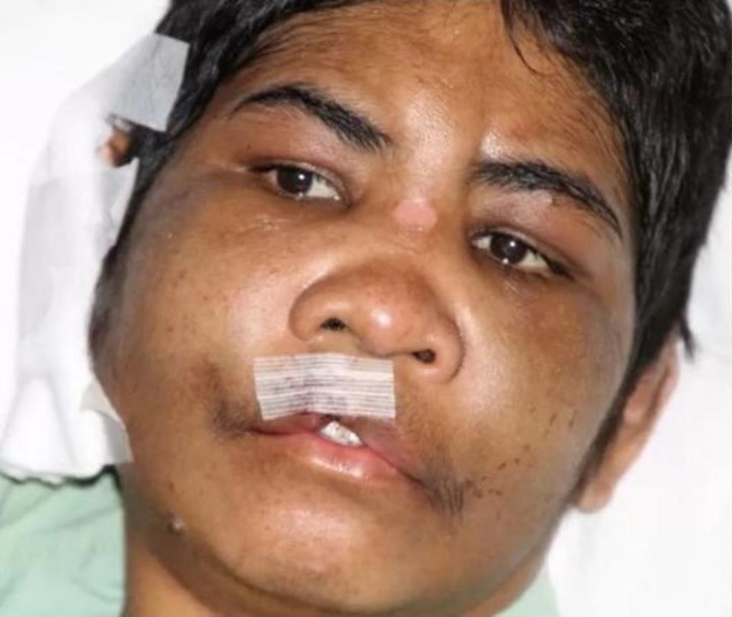 Mariance Kabu (43) saat dalam perawatan di salah satu rumah sakit di Selangor, Malaysia, awal Desember 2014 silam. Ia dianiaya majikannya saat bekerja di Malaysia selama delapan bulan, April-Desember 2014.