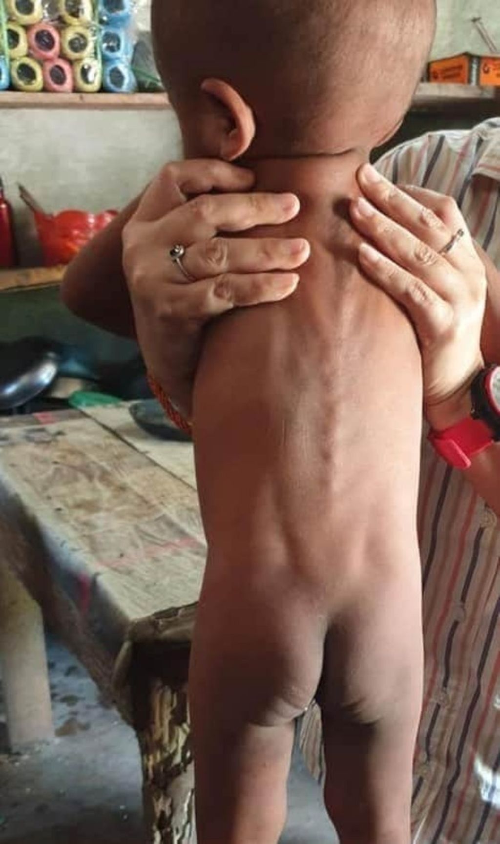Seorang anak menderita gizi buruk di Kecamatan Wewejewa, Kabupaten Sumba Barat Daya, Maret 2020. Dokumen Pokja Stunting NTT.