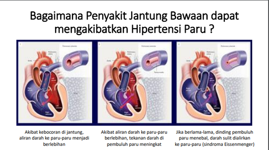 Penyakit jantung bawaan dapat menjadi penyebab sekunder dari hipertensi paru pada anak.