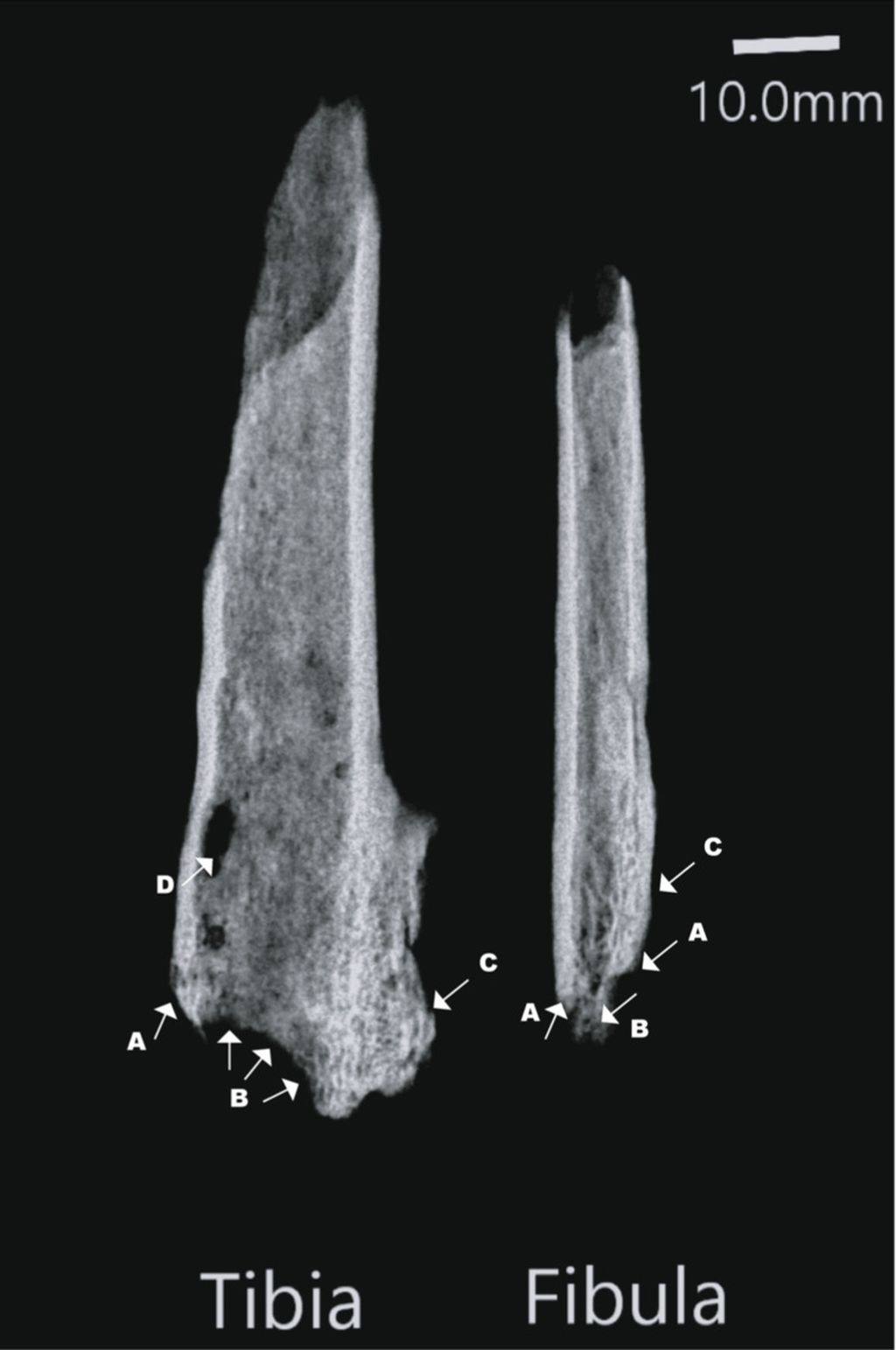 Radiografi anggota badan kerangka distal kiri yang diamputasi, yang ditemukan di Liang Tebo, Kalimantan Timur. Panah putih menunjukkan (A) Margin pemotongan yang jelas menunjukkan penggunaan alat yang tajam (B) Resorpsi tulang karena kurangnya vaskularisasi yang tepat dari jaringan tulang. (C) Osifikasi heterogenik dari membran interoseus. (D) Kerusakan <i>post-mortem</i>. Catatan: fibula ditempatkan postero-anterior. Sumber: Tim Ryan Maloney, dkk, jurnal <i>Nature</i> (2022).