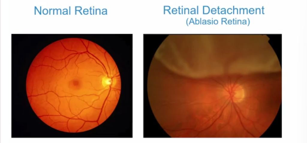 Penampakan retina pada orang dengan kondisi sehat dan orang yang mengalami ablasio retina.