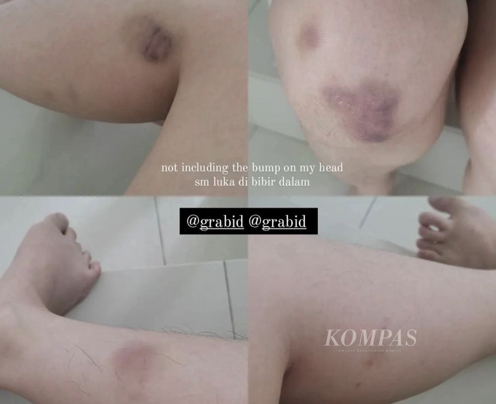 Korban mengunggah luka-luka yang dialaminya di media sosial akibat peristiwa penculikan oleh oknum sopir Grab, Kamis (28/3/2024).
