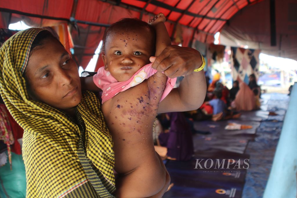 Pengungsi etnis Rohingya menunjukkan anaknya yang terkena penyakit kulit di kamp pengungsian darurat di Desa Karang Gading, Kecamatan Labuhan Deli, Kabupaten Deli Serdang, Sumatera Utara, Rabu (17/1/2024). 