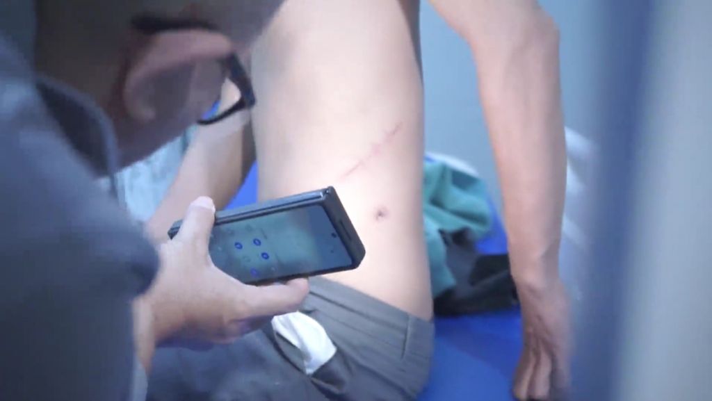 A victim of illegal kidney trade from Cambodia who was subjected to TPPO underwent a physical examination at the Health Center of the Metro Jaya Regional Police Headquarters in Jakarta on Monday (24/7/2023). The examination included checking the initial condition of the scar from the kidney removal surgery.