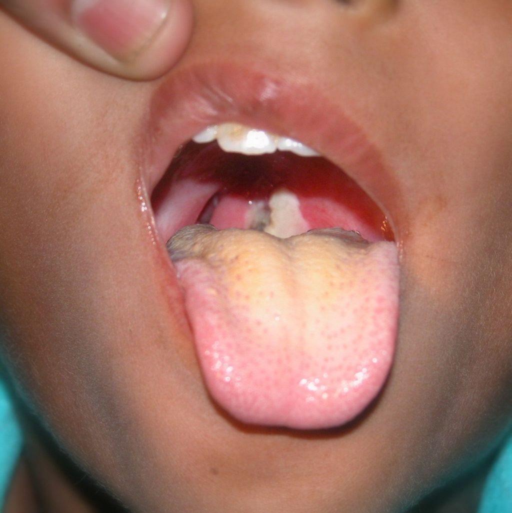 Pseudomembran putih keabu-abuan di hulu kerongkongan atau tenggorokan sebagai penanda difteri.