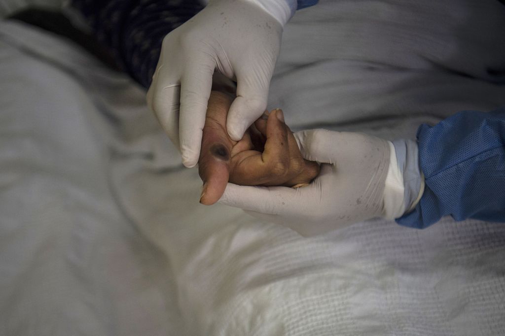 Dokter memeriksa pasien yang mengalami luka akibat infeksi cacar monyet di ruang isolasi di Rumah Sakit Arzobispo Loayza, Lima, Peru, 16 Agustus 2022.