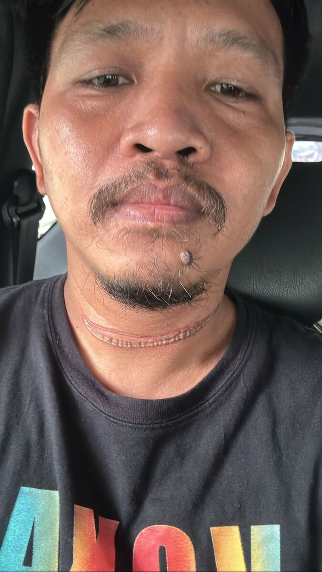 Dwi Yuda Prawira Soefaca (32) harus mengalami luka di lehernya karena terjerat kabel optik yang menjuntai di kawasan Kramatjati, Jakarta Timur.